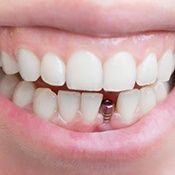 visible dental implant abutment in a person’s smile 