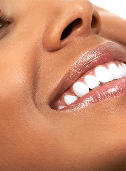 Woman after teeth whitening in Chula Vista