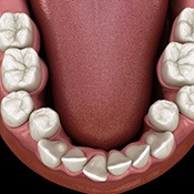 Illustration of crooked teeth