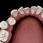 Illustration of gapped teeth