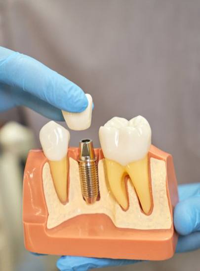 dentist placing a crown onto a model of a dental implant 