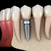 dental implant in the lower jawbone 
