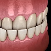 Illustration of an underbite