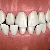 Illustration of a crossbite