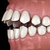 Illustration of an open bite