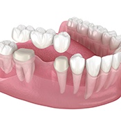 An illustration of a traditional dental bridge anchored to natural teeth in Chula Vista