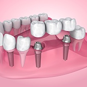 An illustration of an implant bridge supported by two dental implant posts