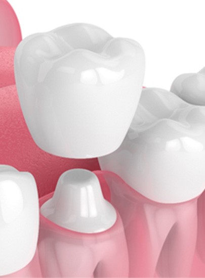 What Is a Dental Crown?