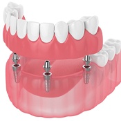 Diagram showing implant dentures in Chula Vista