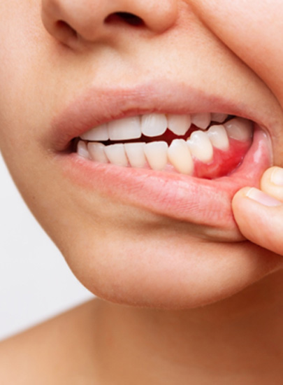 Patient showing red, inflammed gums