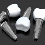three dental implants with abutments and crowns
