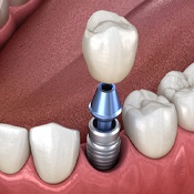 single dental implant with crown