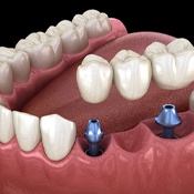 dental implants with bridge