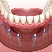 six dental implants with full denture