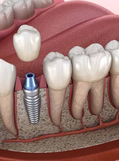 illustration of a dental implant in the jawbone 