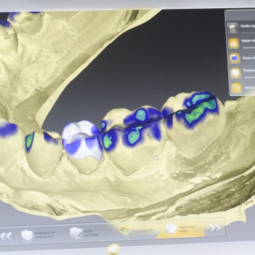 3 D image of teeth on computer screen