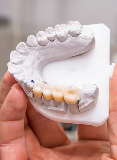 Model smile with dental bridge restoration