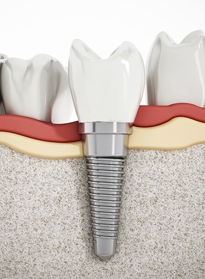 Animated dental implant supported replacement tooth