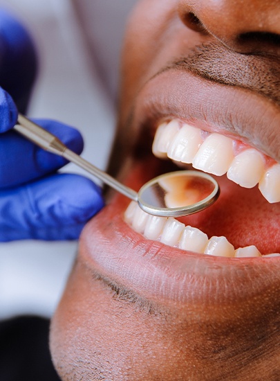 Dentist checking man's tooth colored fillings