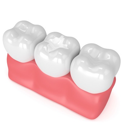 Tooth-colored filling for cavity