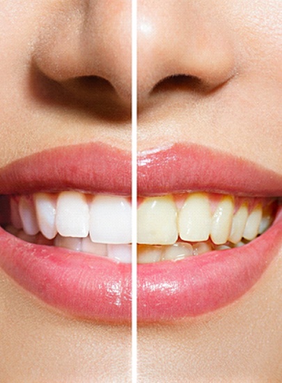 Before and after teeth whitening in Chula Vista