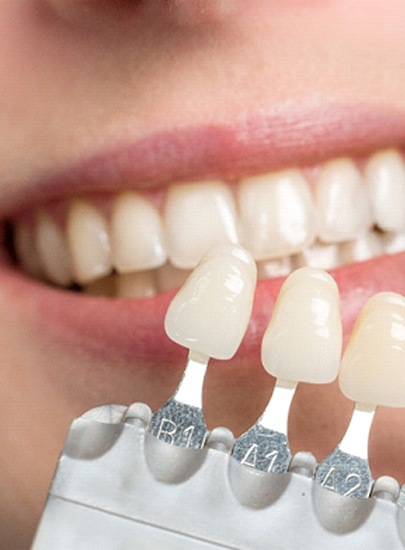 Veneers shades next to patient's smile