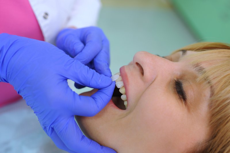 Patient having veneers applied to their teeth