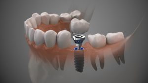 Illustration of a dental implant abutment and crown in a transparent jaw