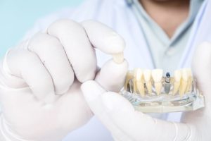 Close up of dentist hands holding model dental implant