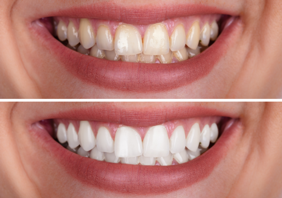 Before and after of a whitened smile