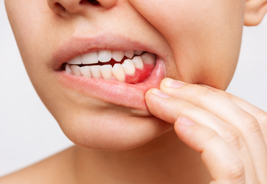 Close up of woman's mouth with inflamed gums