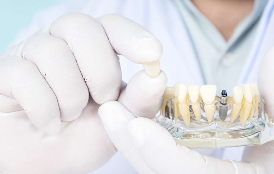 Dental implant model